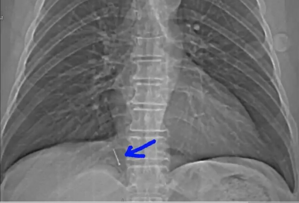 肺里钉子的x光照片