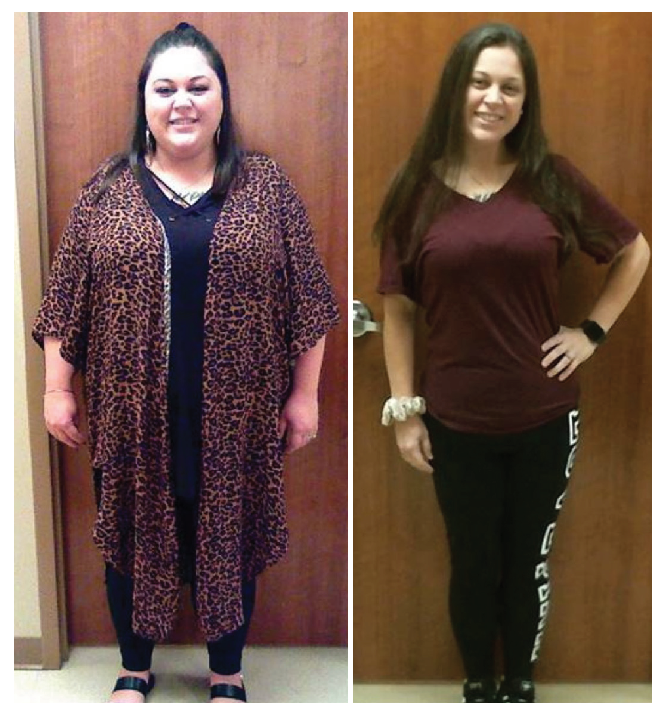 Angel Lubrano before and after bariatric surgery