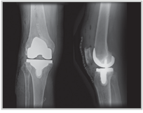 knee replacement x-ray