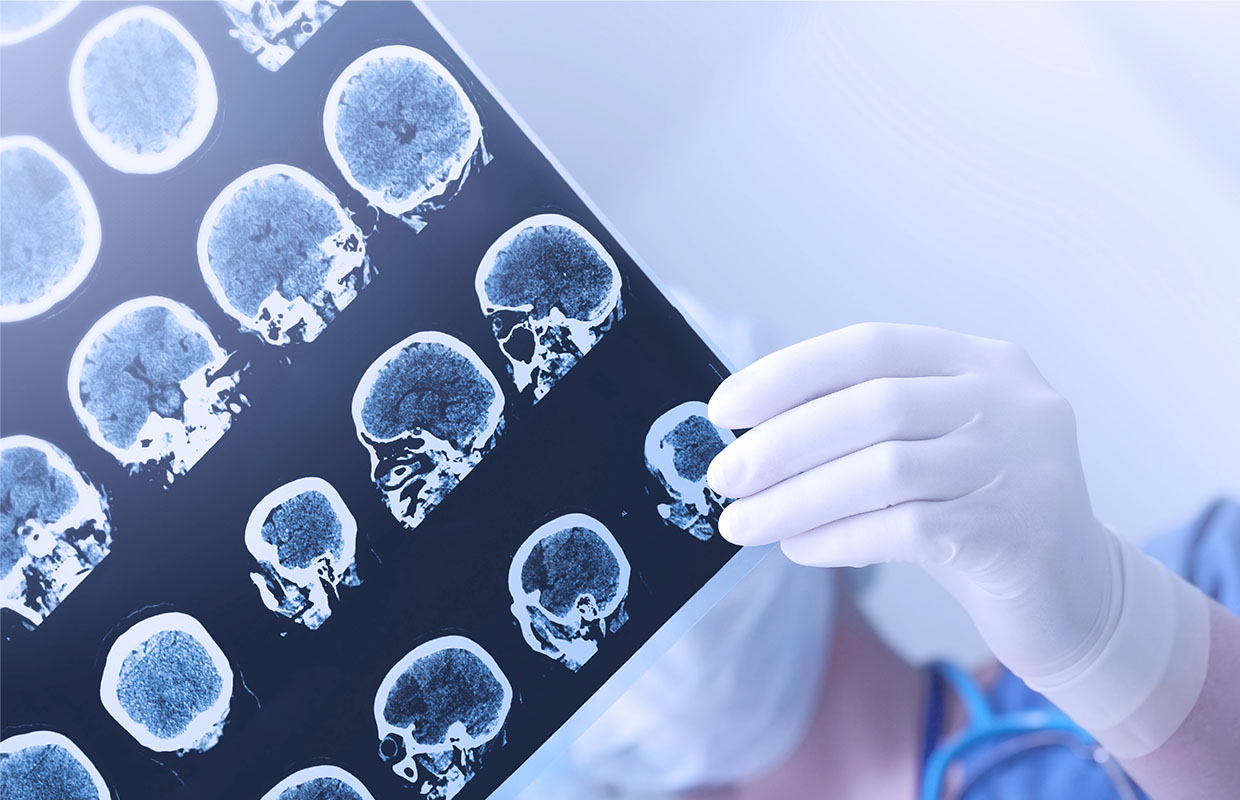 a doctor holds a printed mri of a brain