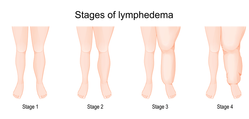 Severity of lower extremity lymphedema in different stages. Vector illustration