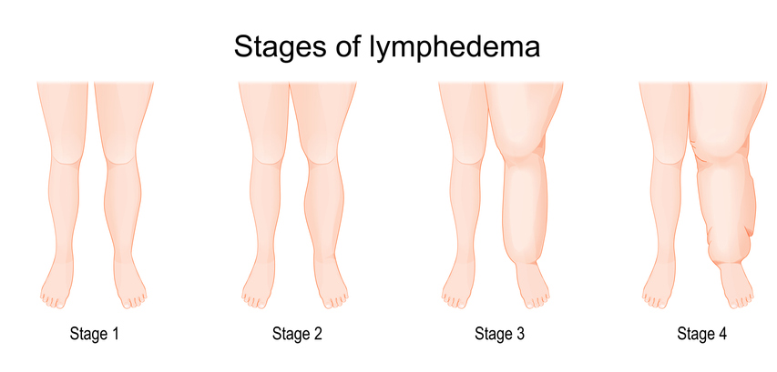 Compression Wear for Lymphedema - Lymphedema Therapy Specialists