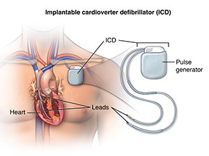 implantable cardioverter defibrillator icd