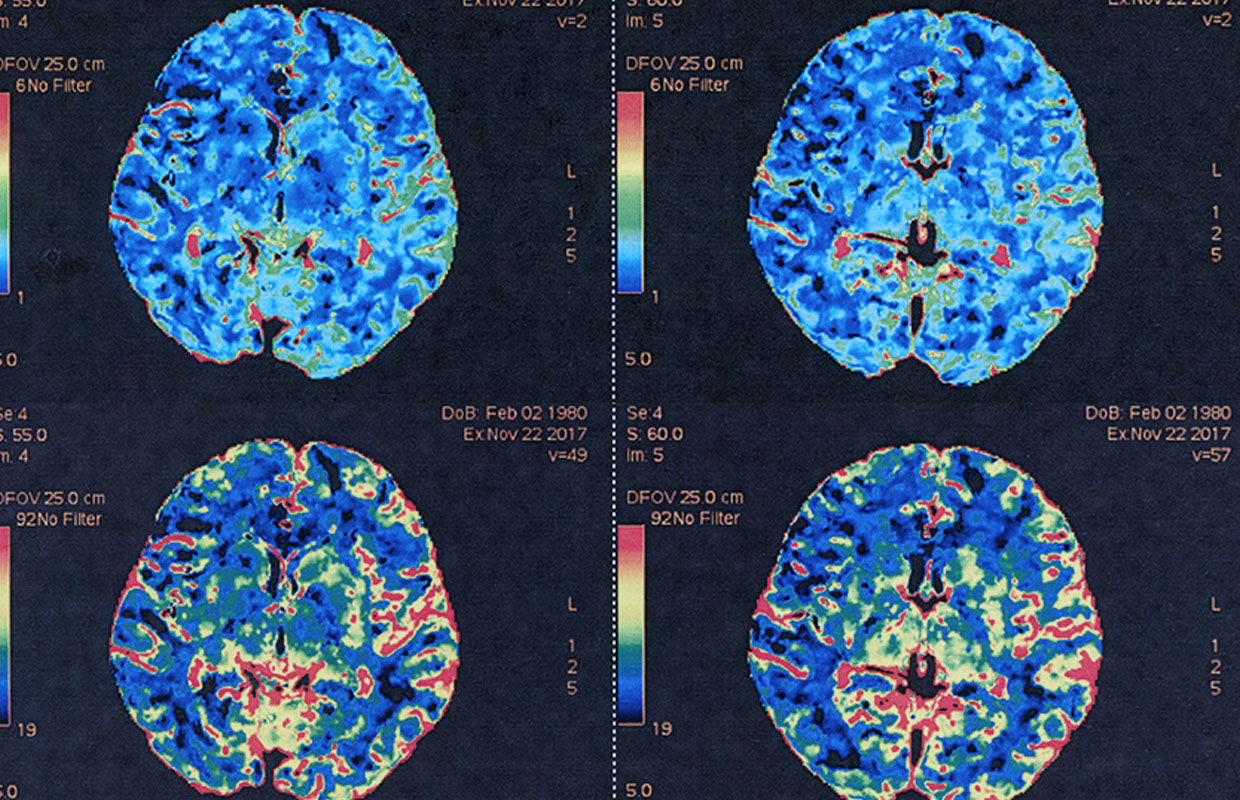 a computer generated image of a brain scan from an mri