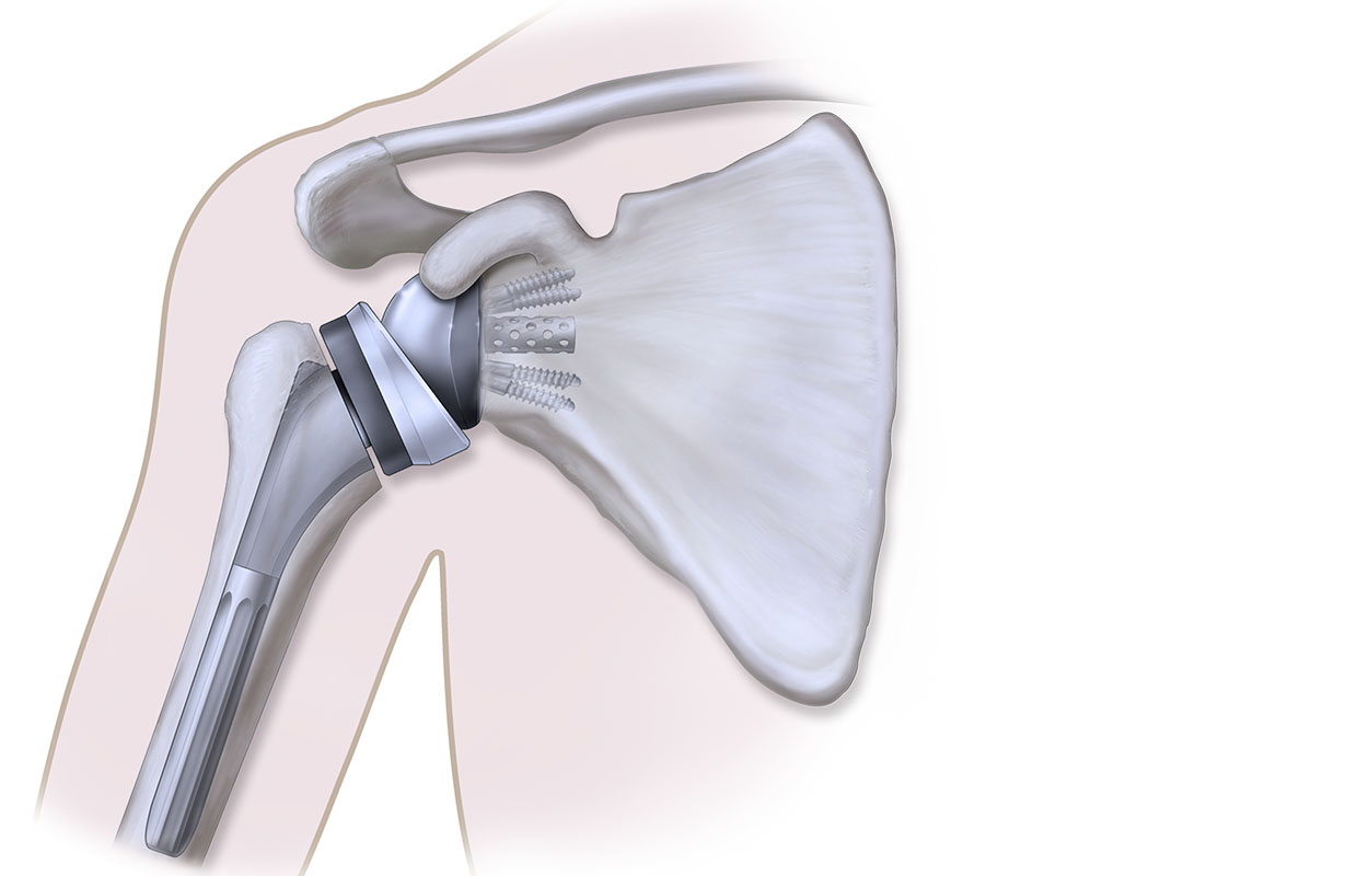 graphic of reverse shoulder replacement