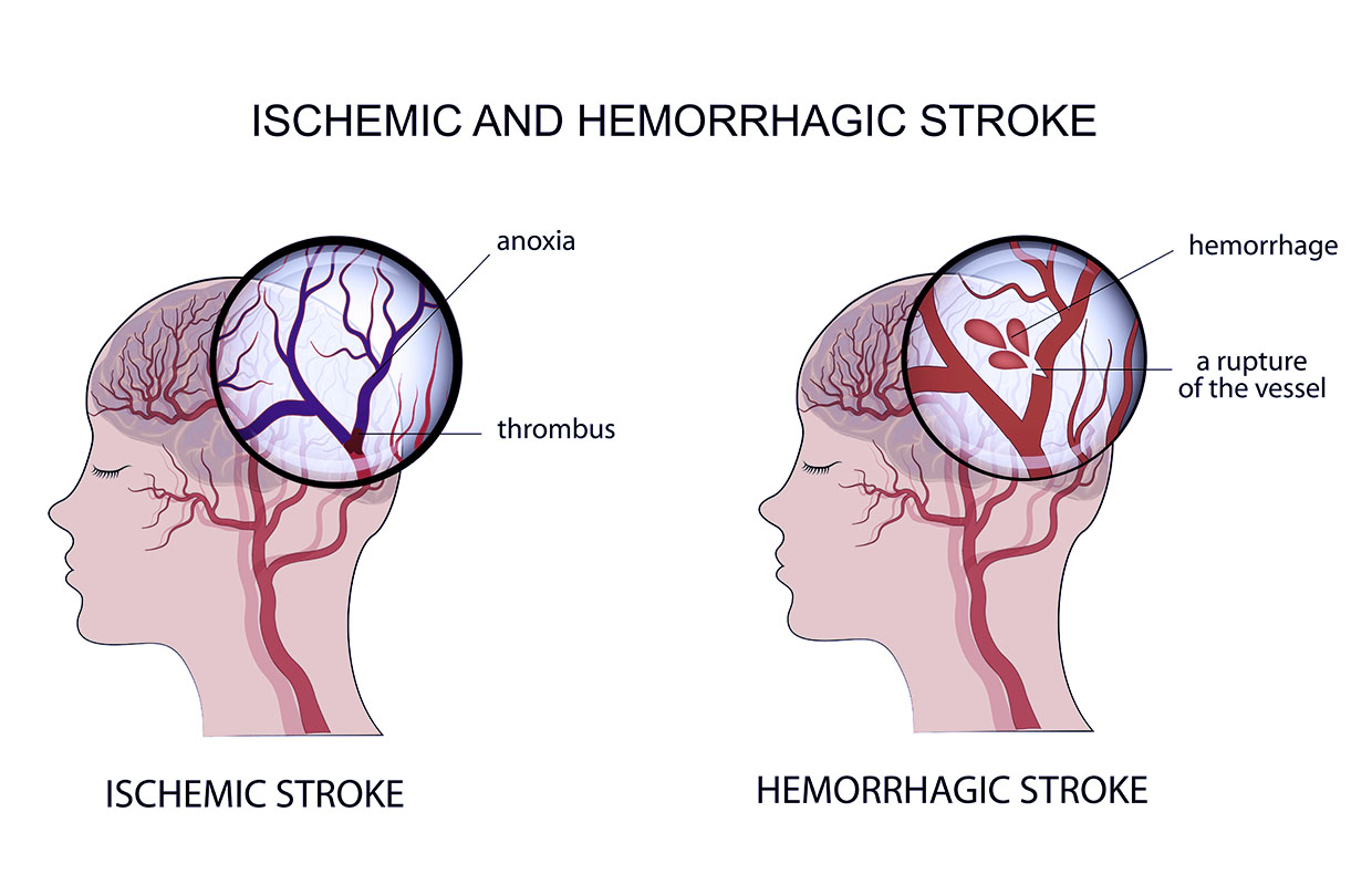 A graph showing the differences between ischemic and hemorrhagic strokes