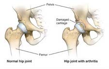 diagrame of hip joint with and without arthritis