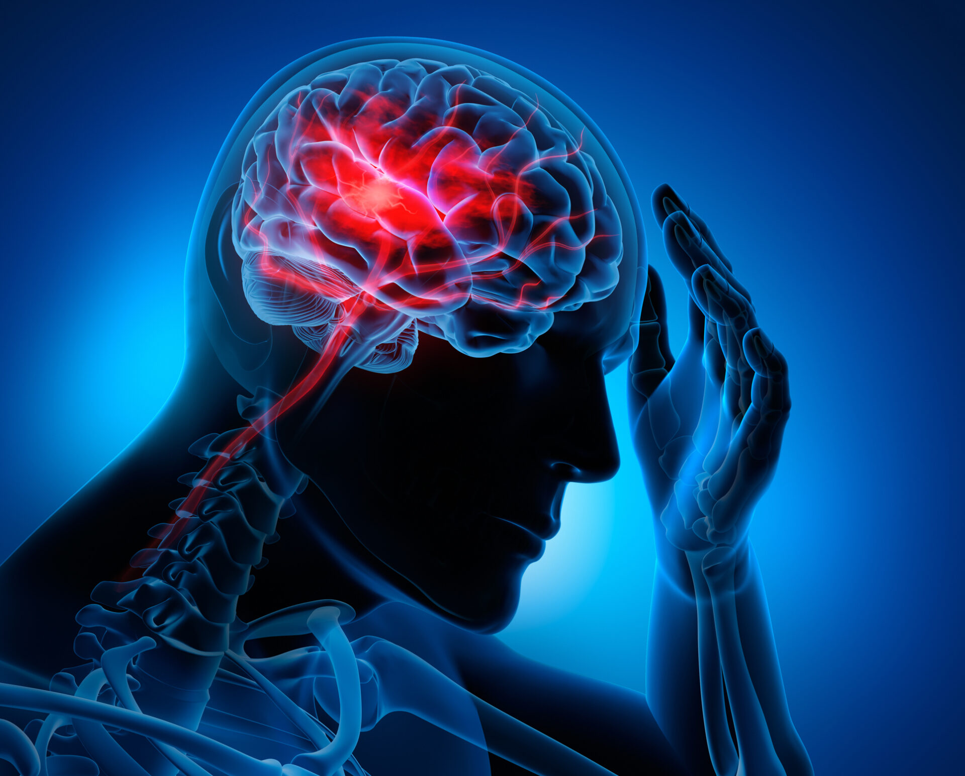 Medical illustration of a brain with stroke symptoms