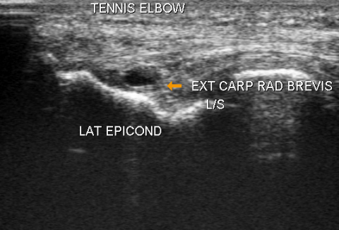 Elbow ultrasound