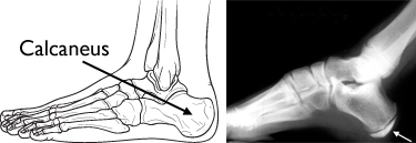 seivers Sever's Disease