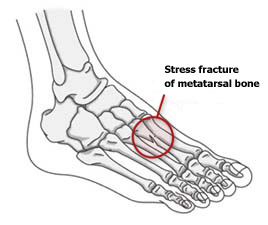 Stress fracture