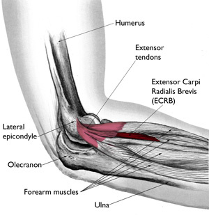 Tennis elbow