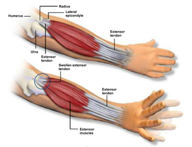 Tennis elbow