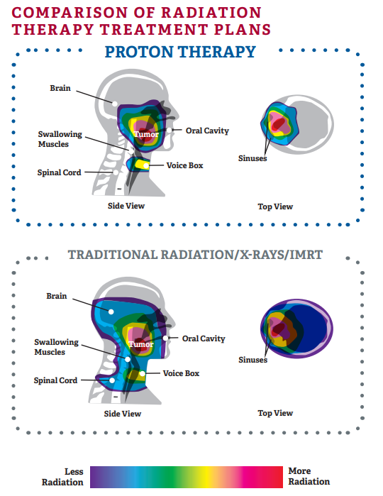 comparative treatment plan for proton therapy for head and neck cancer