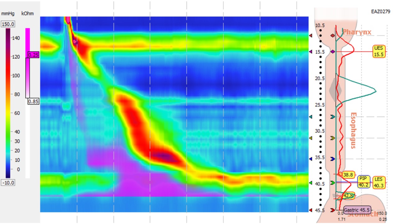 High Resolution Esophageal Manometry with Impedance chart