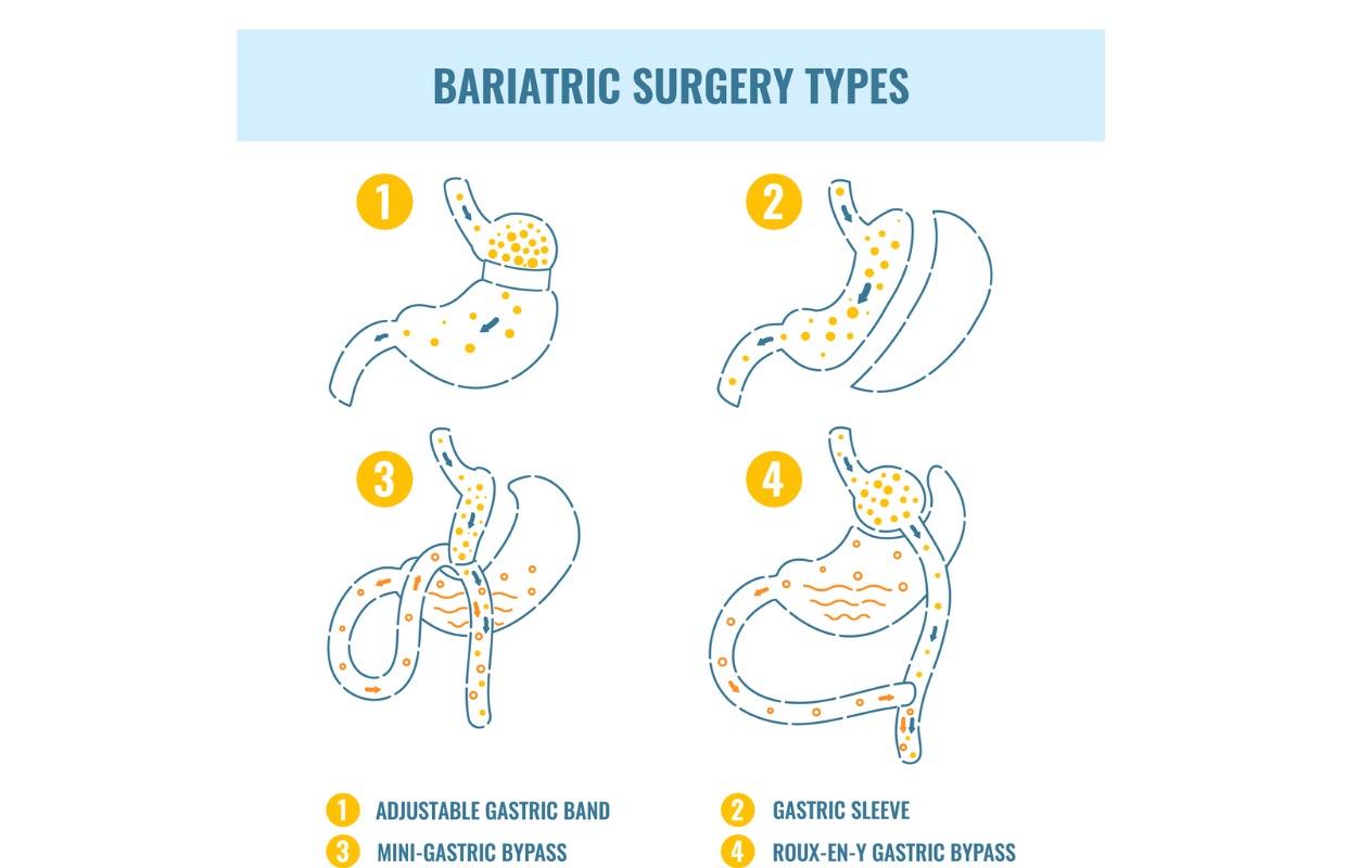 The four different types of bariatric surgery include gastric band, gastric sleeve, biliary pancreatic diversion and gastric bypass.