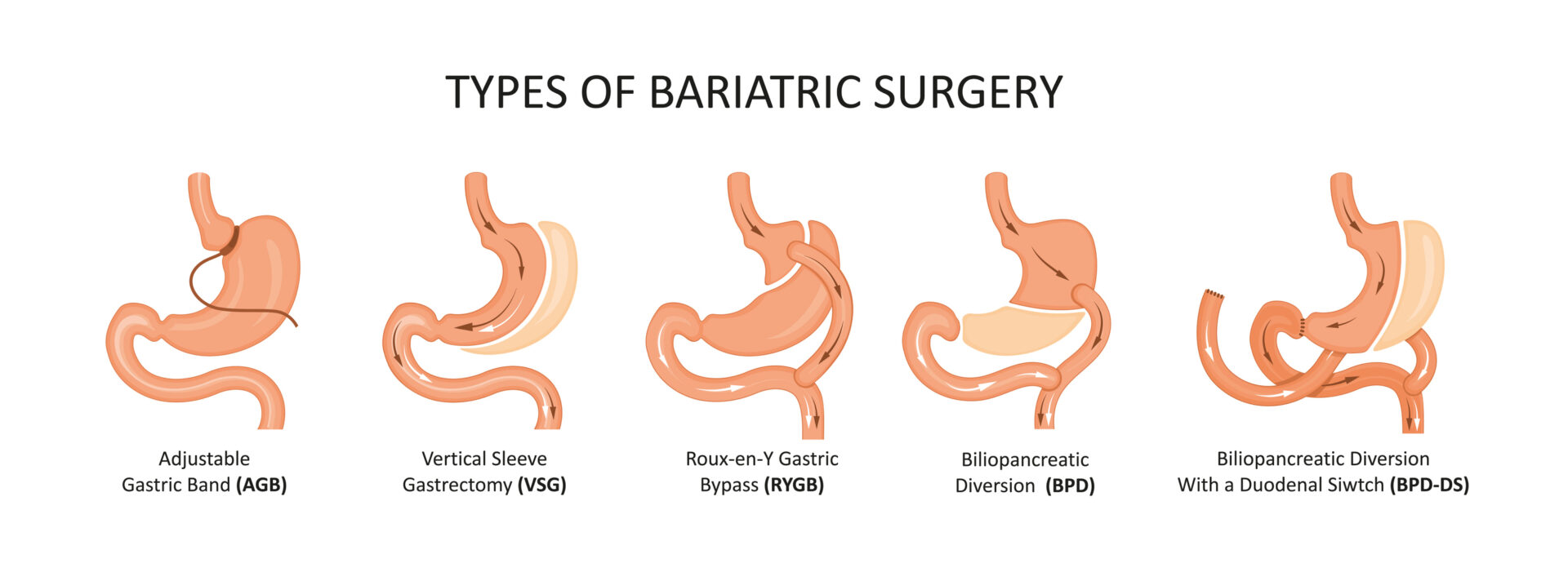 The four types of bariatric surgery include gastric banding, gastric sleeve, gastric bypass and biliary pancreatic diversion.