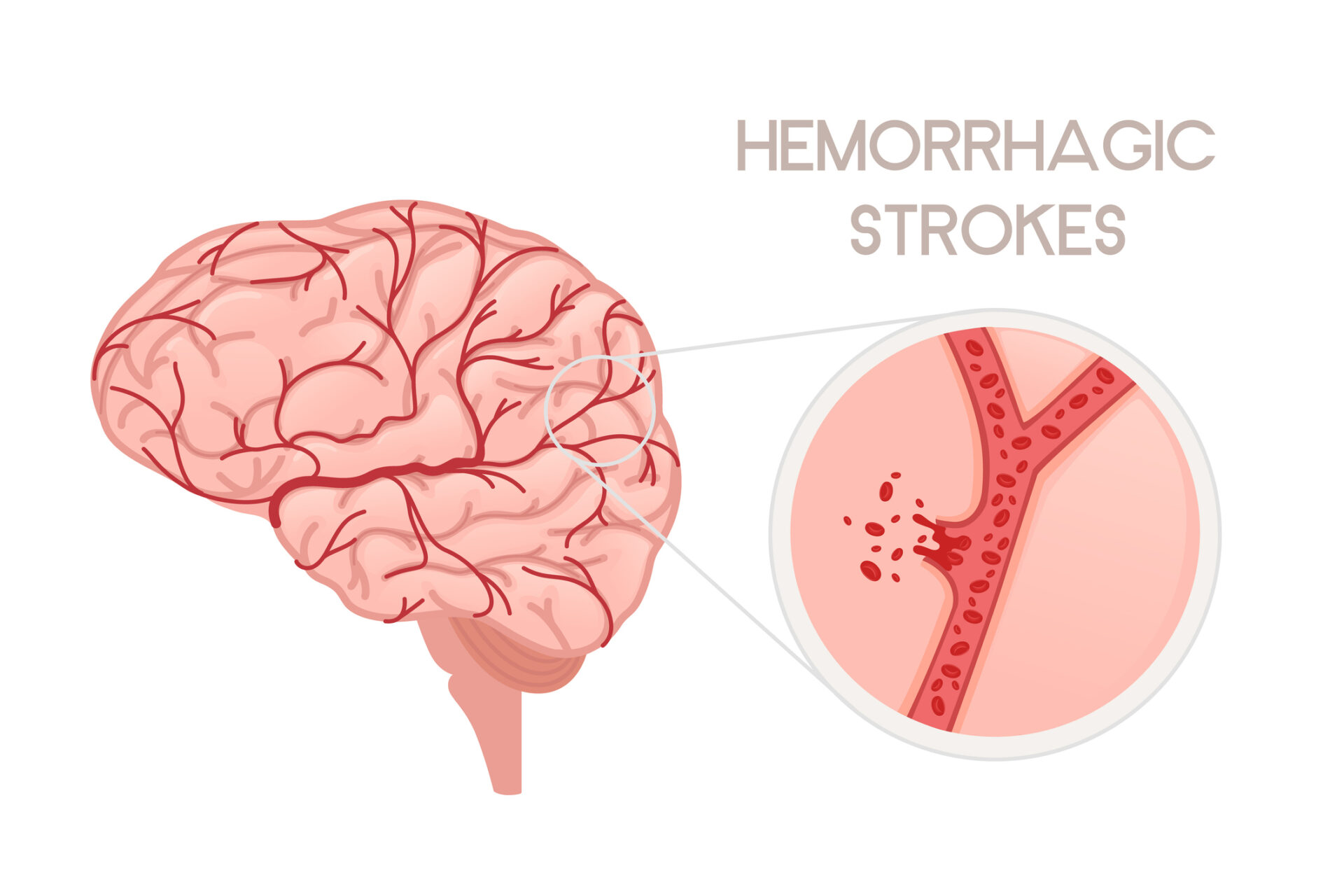 Blood vessel burst inside of the brain causing hemorrhagic stroke.