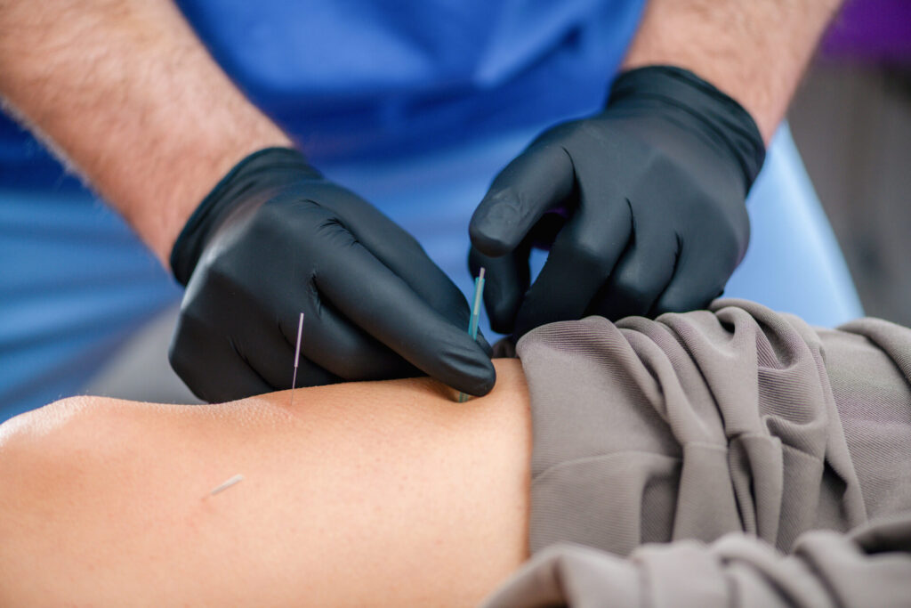 A person wearing black gloves inserts thin acupuncture needles into a patients exposed arm, which is resting on a surface. The background is blurred, focusing on the procedure.