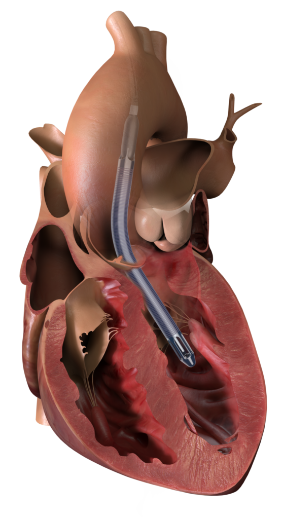 Medical illustration of a human heart with a minimally invasive heart pump (ventricular assist device) implanted, showing the device's position and components inside the heart chambers and aorta.