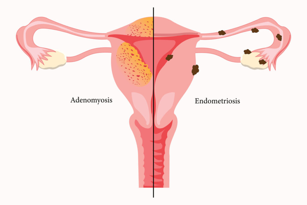 Medical illustration of a uterus, with adenomyosis shown on the left as tissue inside the uterine wall and endometriosis on the right as tissue outside the uterus on pelvic organs.