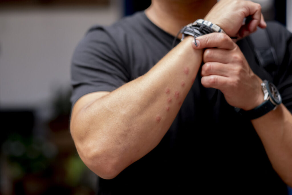 7 Most Common Bug Bites in East Tennessee and How to Treat Them