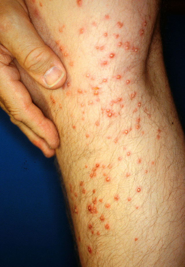 A close-up of a persons lower leg with numerous red bumps and pustules on the skin, possibly indicating a rash or skin infection. A hand is resting on the upper part of the leg.