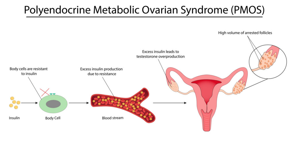 Diagram explaining PMOS: Insulin resistance causes excess insulin, leading to high testosterone and numerous arrested ovarian follicles. Includes liver, bloodstream, uterus, and close-up of ovary with many follicles.